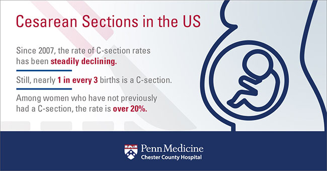 Facts About Cesarean Sections